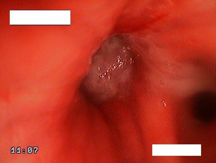 Endophotos. Part 4. Trachea and bronchi - My, The medicine, Endoscopy, Cancer and oncology, Bronchoscopy, Longpost