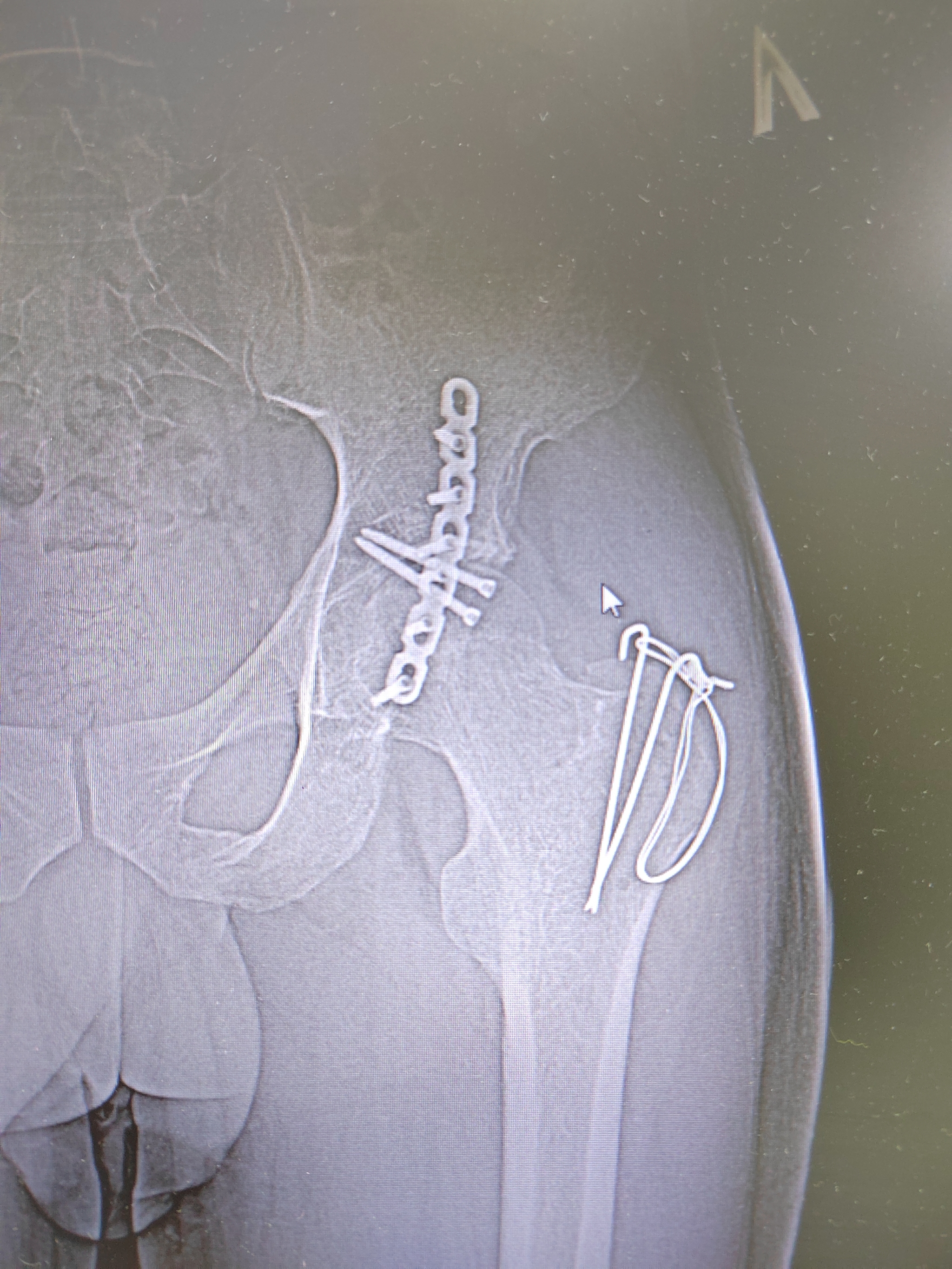 Continuation of the post Fracture of the acetabulum - Broken leg, Trough, Hip bone, Osteosynthesis, Rehabilitation, Reply to post, Longpost, Disease, Disease history