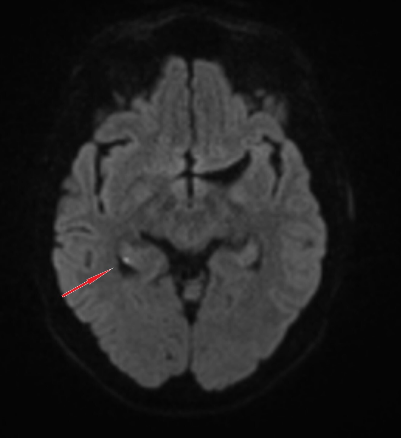 Radiology Case Study: Amnesia - My, Neurology, Radiology, CT, MRI, Amnesia, Video, Soundless, Vertical video, Longpost