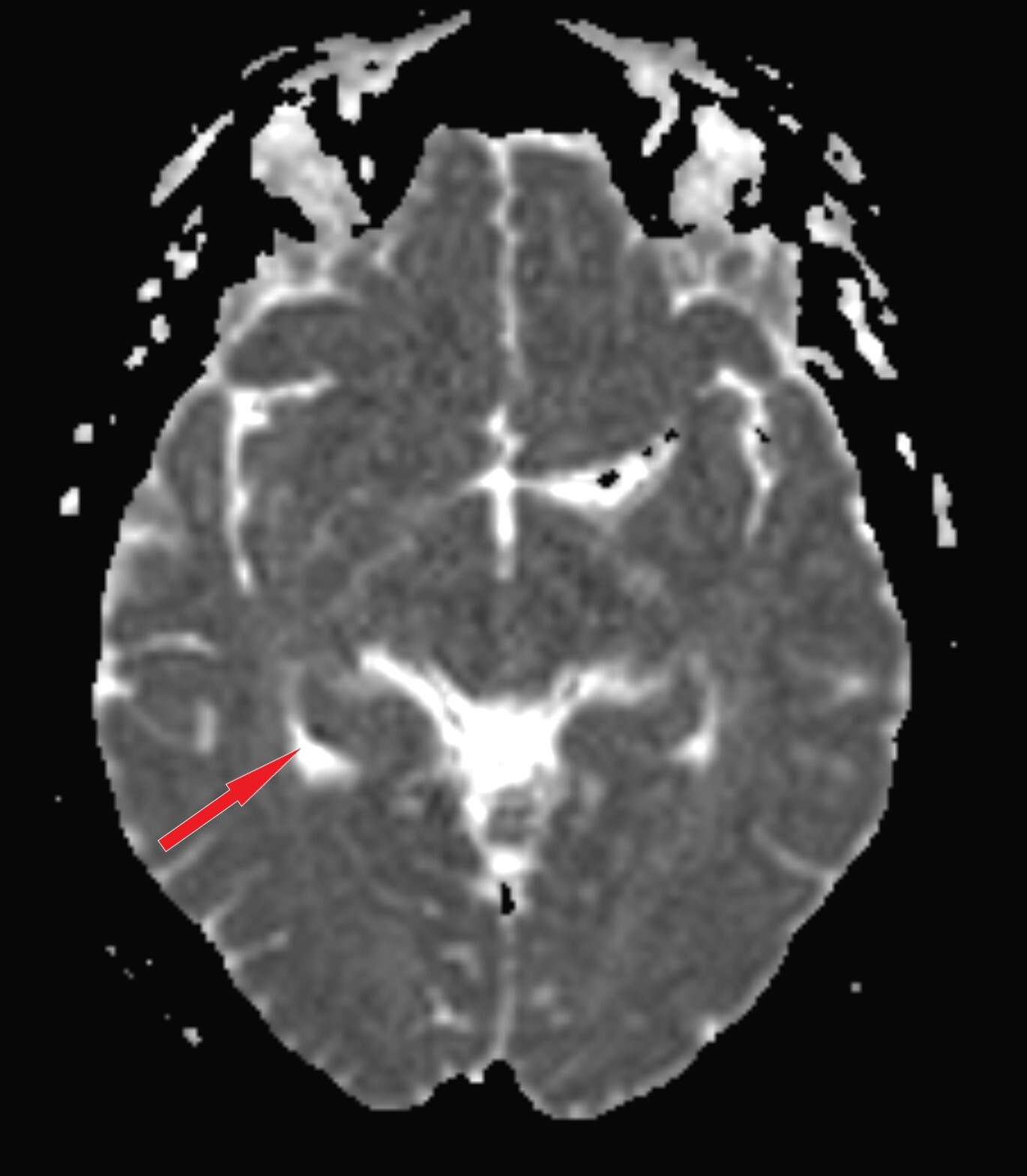 Radiology Case Study: Amnesia - My, Neurology, Radiology, CT, MRI, Amnesia, Video, Soundless, Vertical video, Longpost