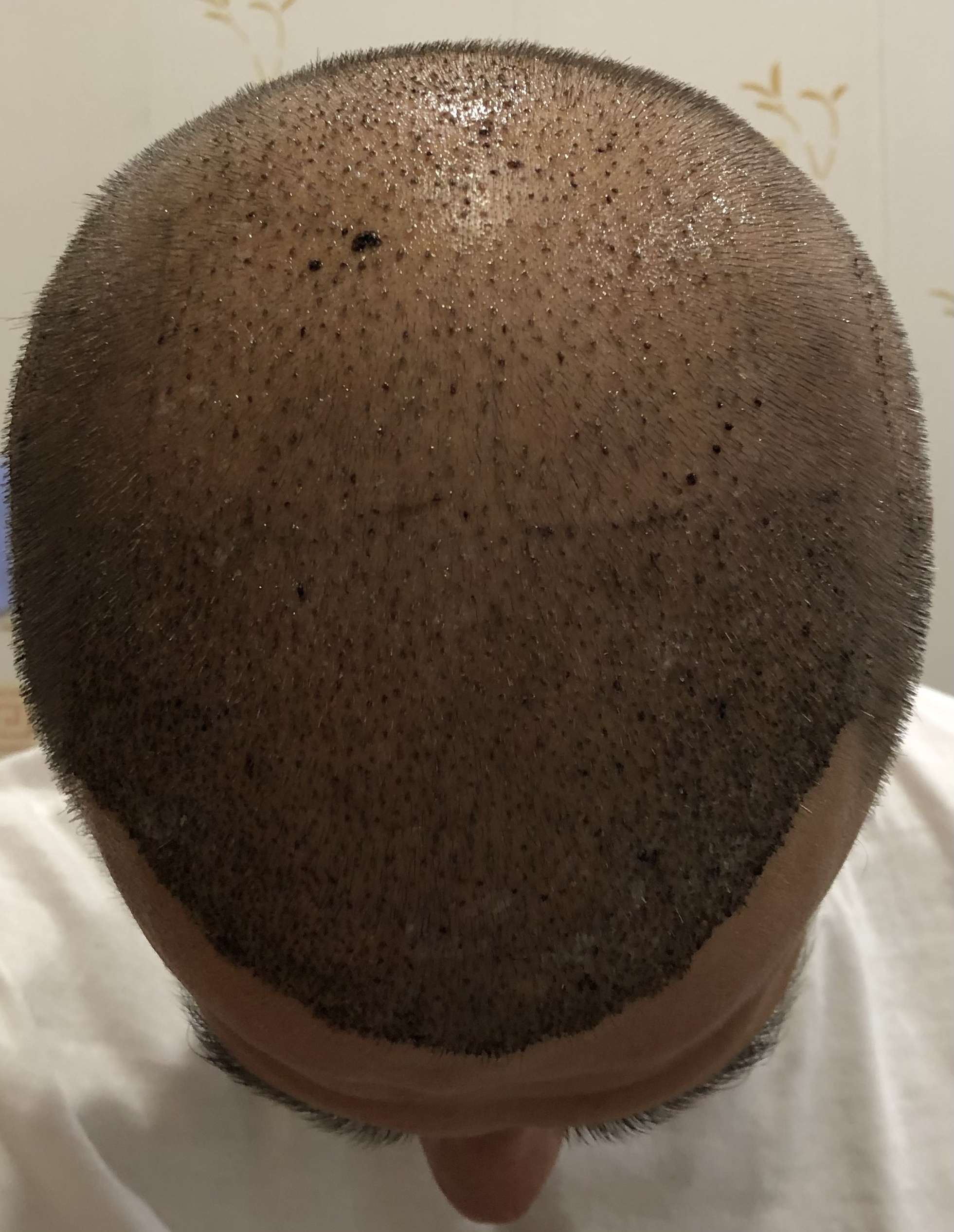 4 months after transplant - Hair Transplant, Joy, Mat, Longpost