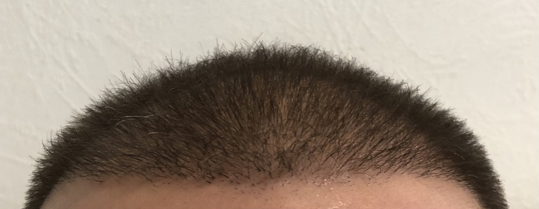 4 months after transplant - Hair Transplant, Joy, Mat, Longpost