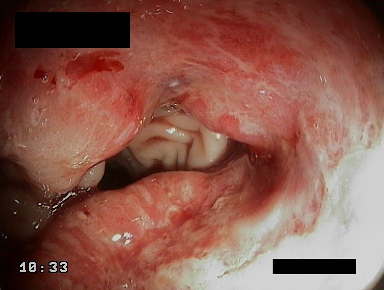 Endophotos. Part 5. The Empire Strikes Back - My, Cancer and oncology, Polyps, Nematodes, Video, Longpost