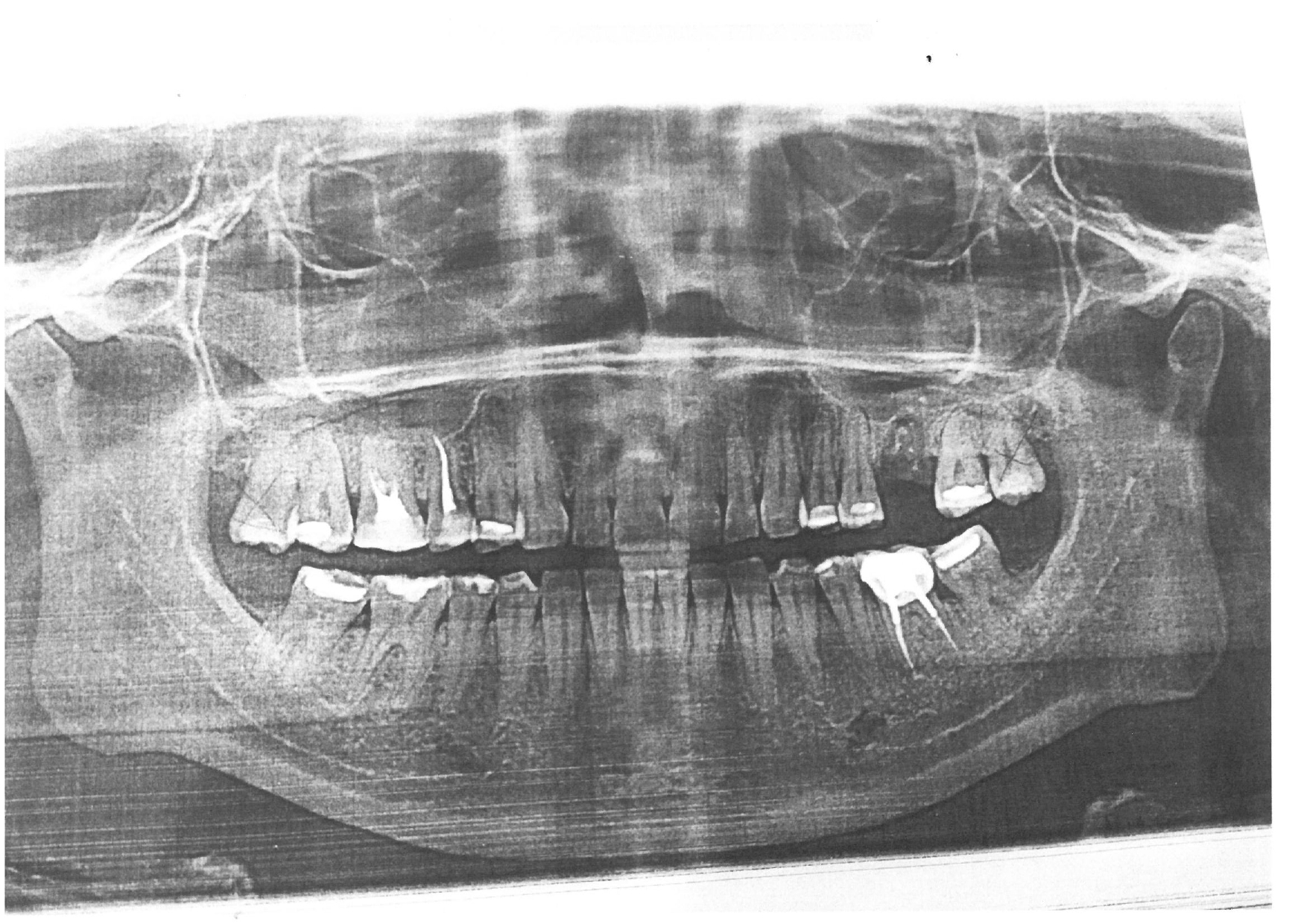 Implant or bridge? - My, Operation, Teeth, Dentistry, Doctors, Help me find, Treatment, Dental implantation, Need advice, Video, Longpost