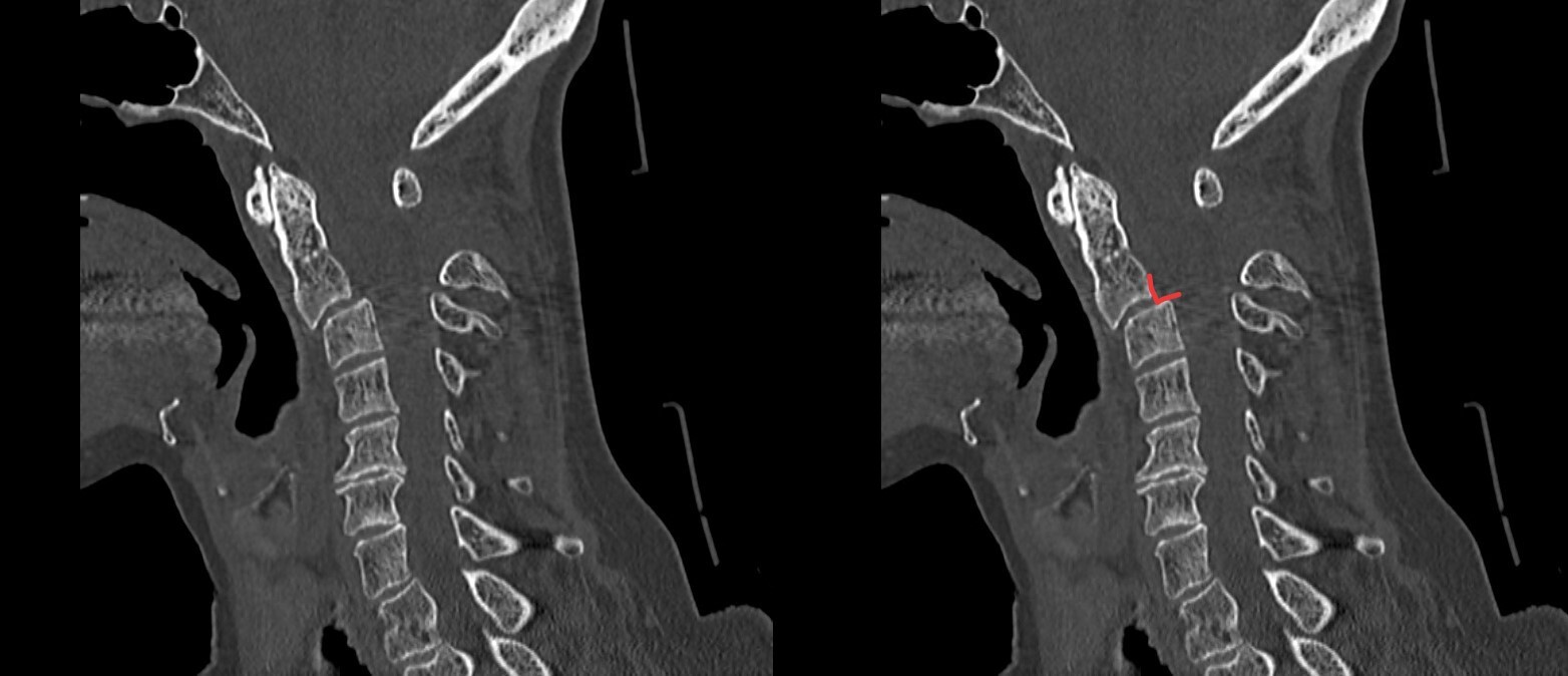 Случаи из радиологической практики: перелом висельника | Пикабу