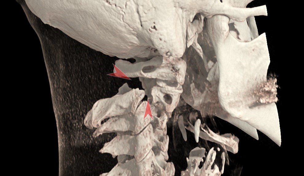 Cases from radiological practice: gallows fracture - My, Fracture of the spine, CT, Radiology, Video, Soundless, Longpost