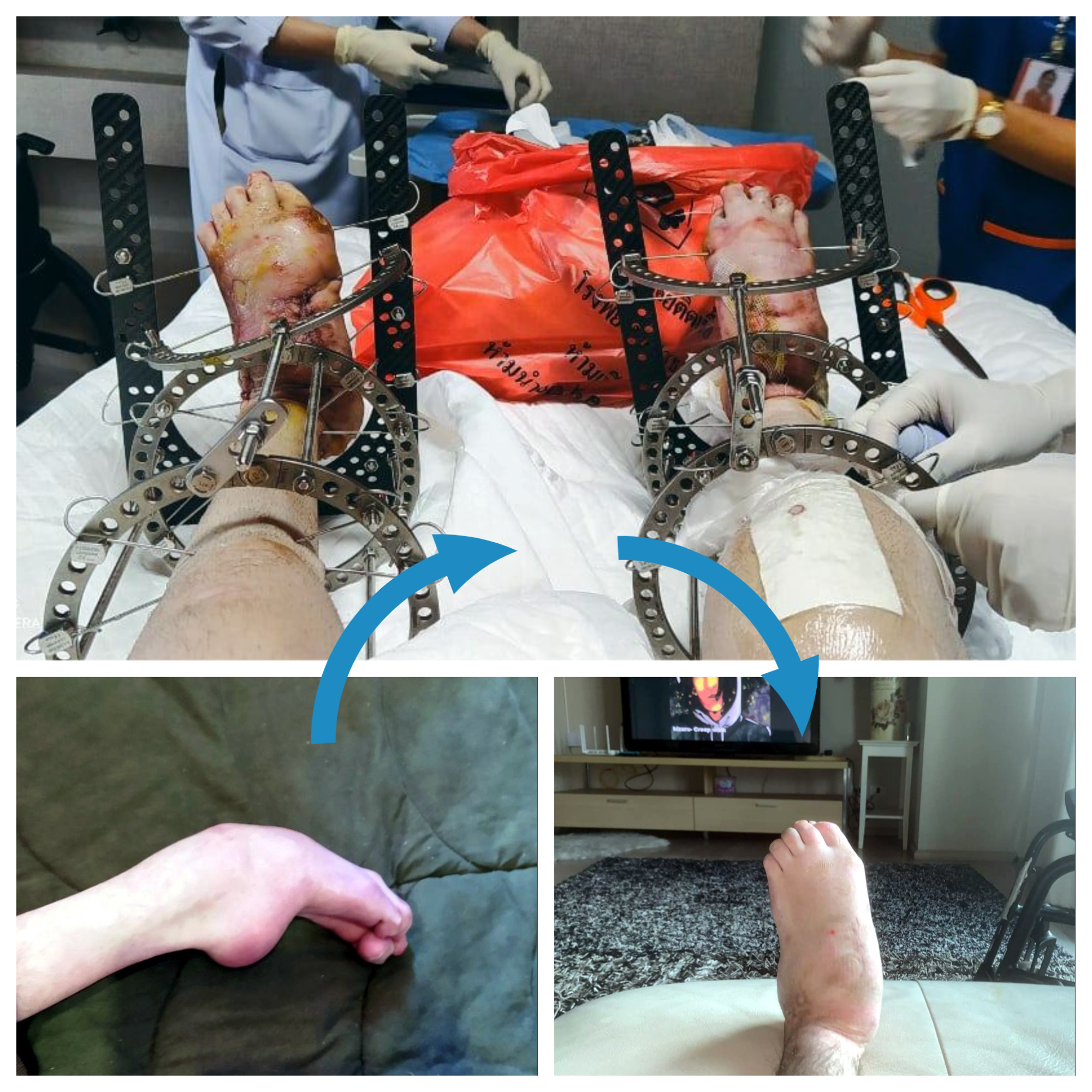 Leg upgrade - My, Disabled person, Doctors, Operation, Treatment, Disease history, Legs