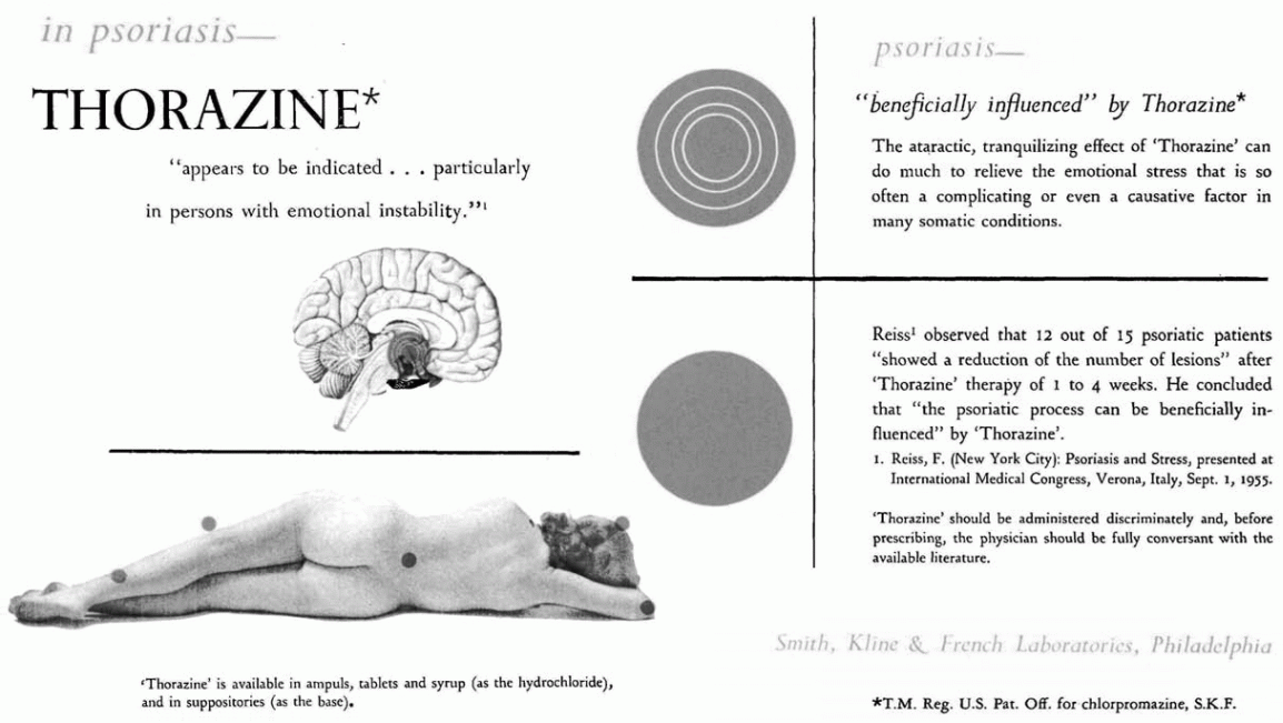 Lobotomy - a nightmare of the 20th century - My, Informative, Story, Facts, Nauchpop, Lobotomy, USA, Psychiatry, The science, Video, Youtube, Longpost