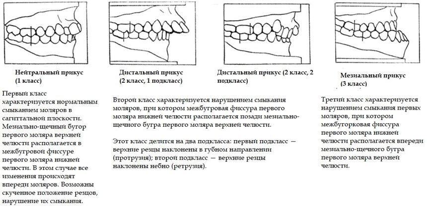 Correction of distal occlusion. MOT of the mouth and some interesting things - My, Personal experience, Dylk, Orthodontics, Teeth, Braces, Bite, Bite correction, Malocclusion, Distal bite, Jaws, Text, Dentistry, Treatment, Disease history, Positive, Longpost