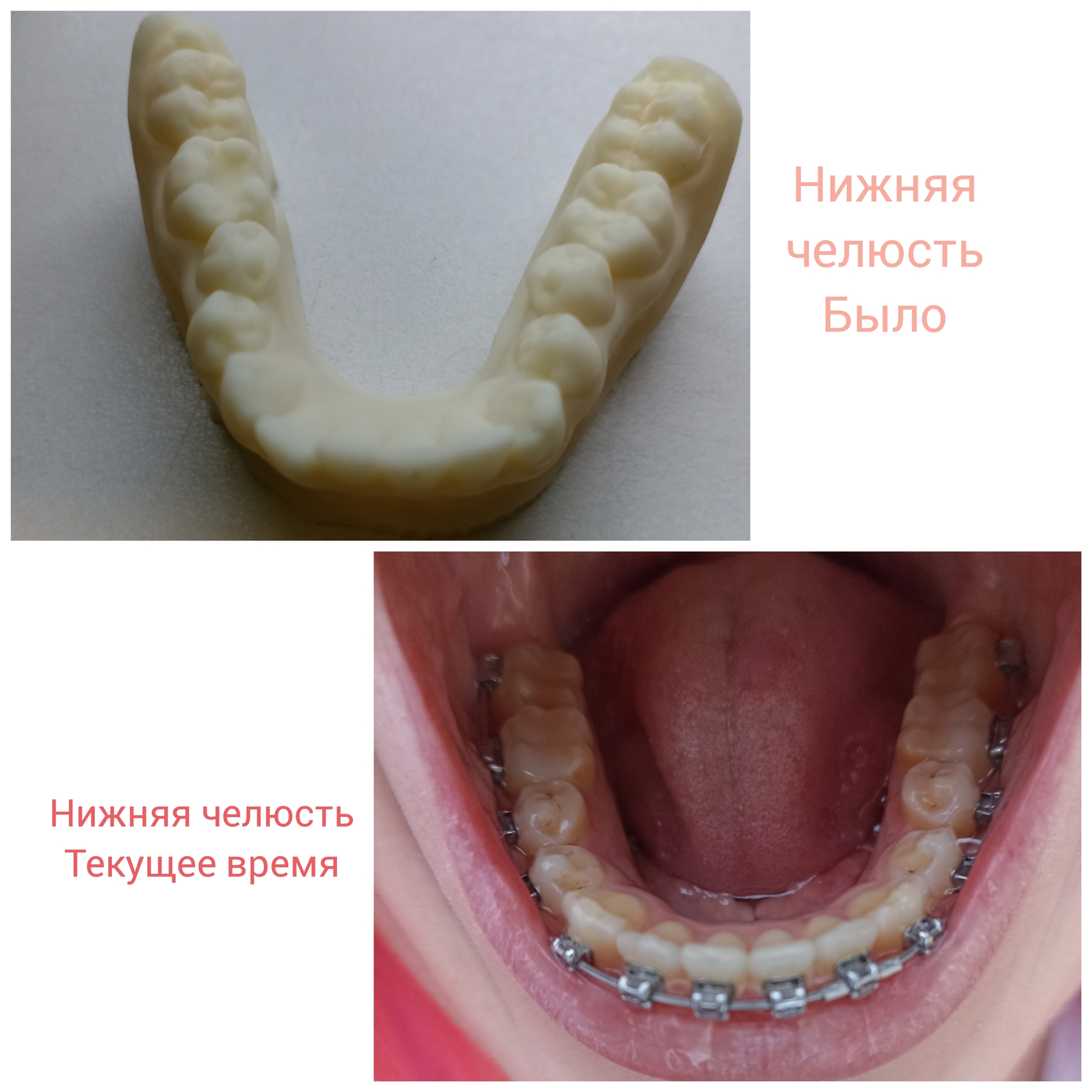 Correction of distal occlusion. MOT of the mouth and some interesting things - My, Personal experience, Dylk, Orthodontics, Teeth, Braces, Bite, Bite correction, Malocclusion, Distal bite, Jaws, Text, Dentistry, Treatment, Disease history, Positive, Longpost