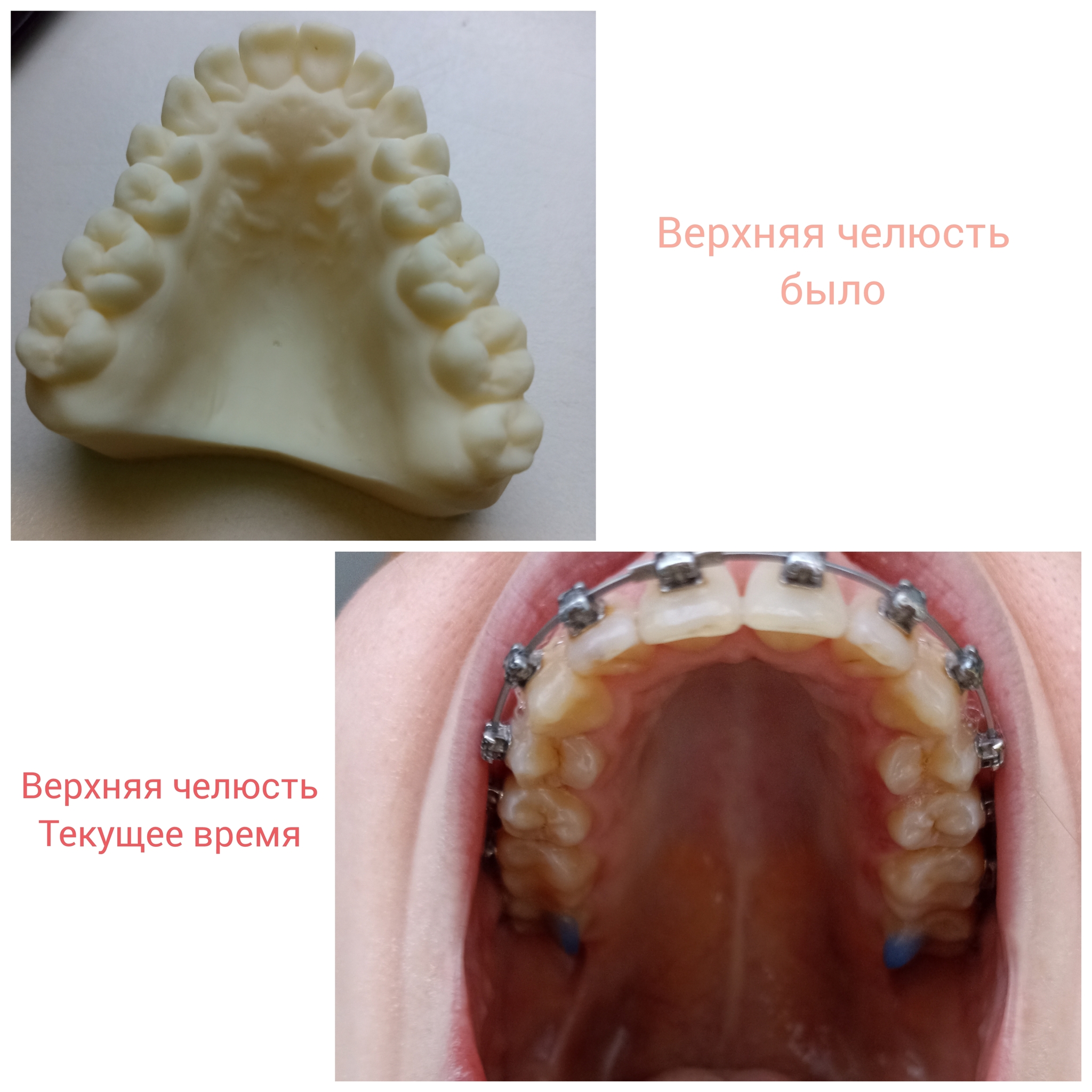 Correction of distal occlusion. MOT of the mouth and some interesting things - My, Personal experience, Dylk, Orthodontics, Teeth, Braces, Bite, Bite correction, Malocclusion, Distal bite, Jaws, Text, Dentistry, Treatment, Disease history, Positive, Longpost