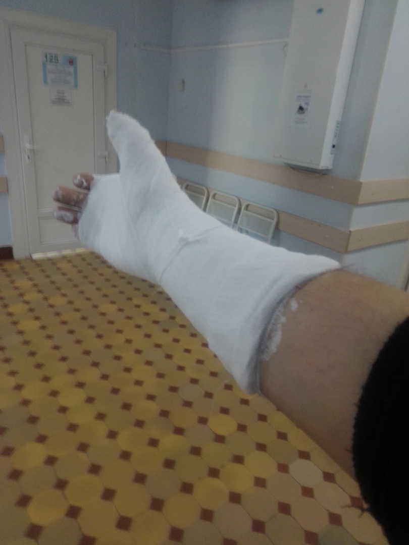 How much progress has been made. - My, Injury, 3D печать, Longpost